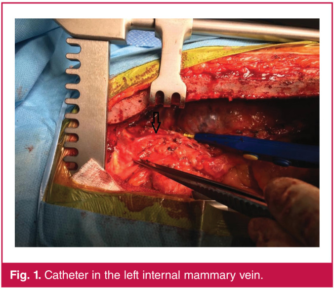 Very rare malposition of central venous catheter in cardiac surgery patients.