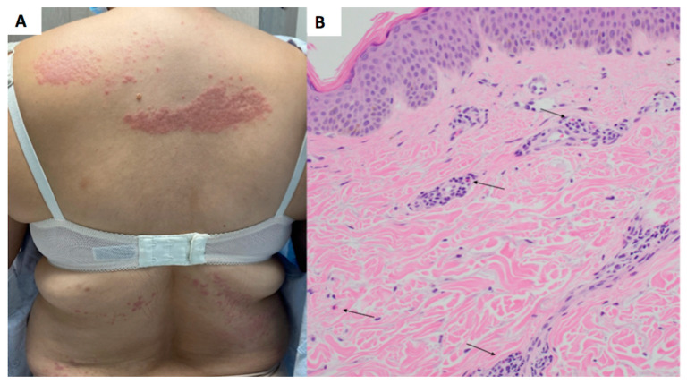 Dermatomyositis with Eosinophils.