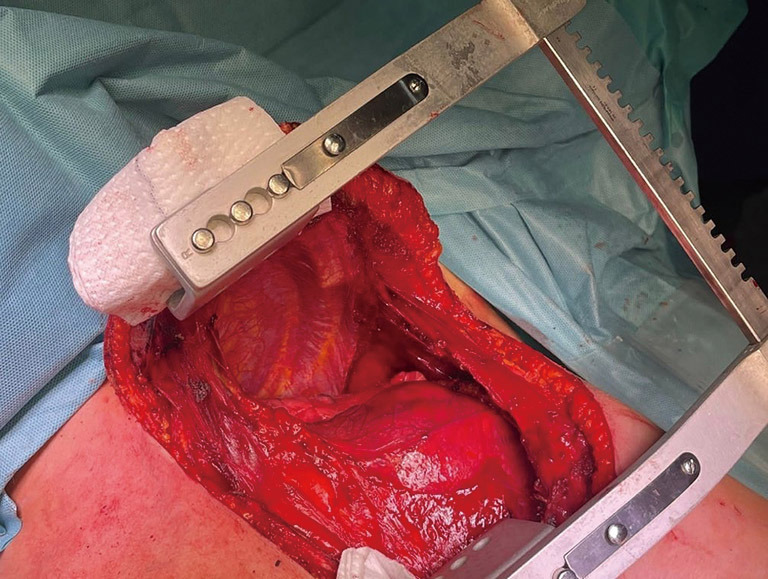 The hemiclamshell approach to bulky cervico-mediastinal lesions: how to do it.