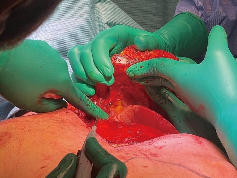 The hemiclamshell approach to bulky cervico-mediastinal lesions: how to do it.