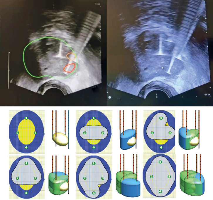 One-year Follow-up Results of Transperineal Biopsy For Patients Undergoing Irreversible Electroporation Treatment in Localized Prostate Cancer.