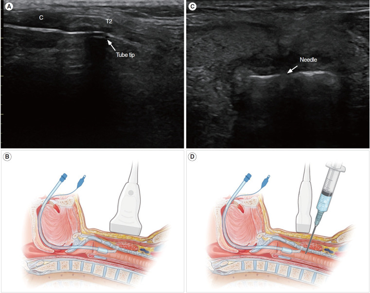 Comparison between Real-Time Ultrasound-guided Percutaneous Dilatational Tracheostomy and Surgical Tracheostomy in critically ill Patients: A Randomized Controlled Trial.