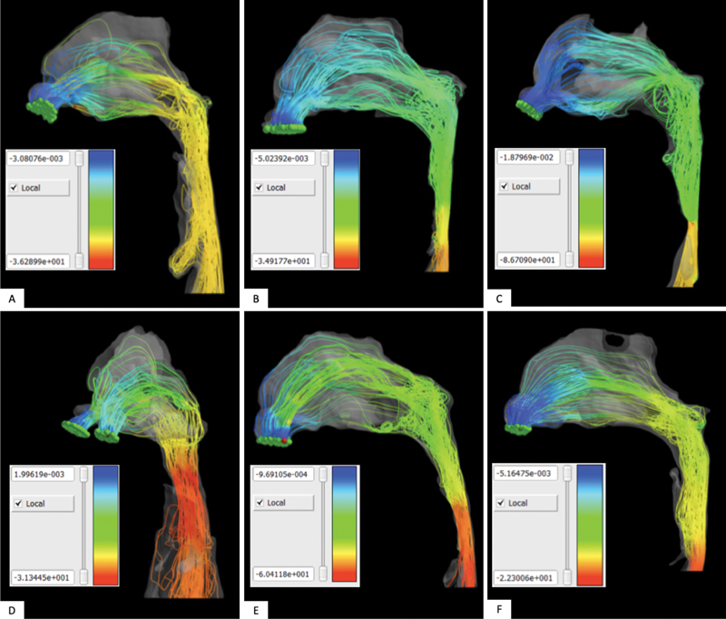 Effects of 3D Airway Geometry on the Airflow of Adults with Cleft Lip and Palate and Obstructive Sleep Apnea: A Functional Imaging Study.