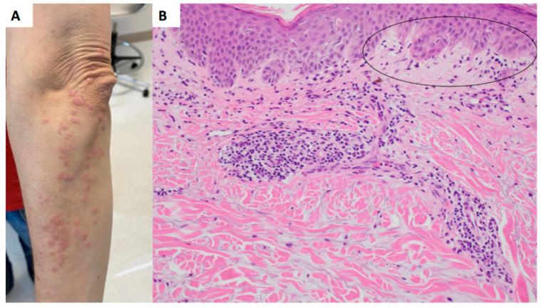 Dermatomyositis with Eosinophils.