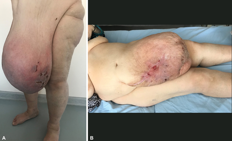 Massive Localized Abdominal Lymphedema: A Case Report with Literature Review.