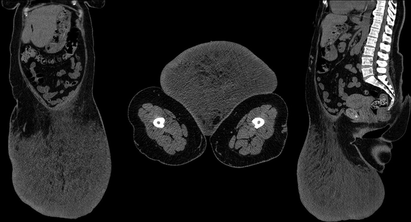 Massive Localized Abdominal Lymphedema: A Case Report with Literature Review.