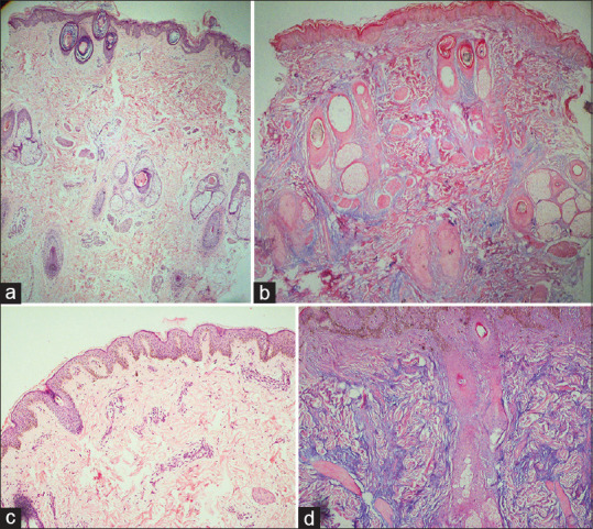 Mucinous Lupus Alopecia with Papulonodular Mucinosis as a Sole Cutaneous Manifestation of Systemic Lupus Erythematosus.