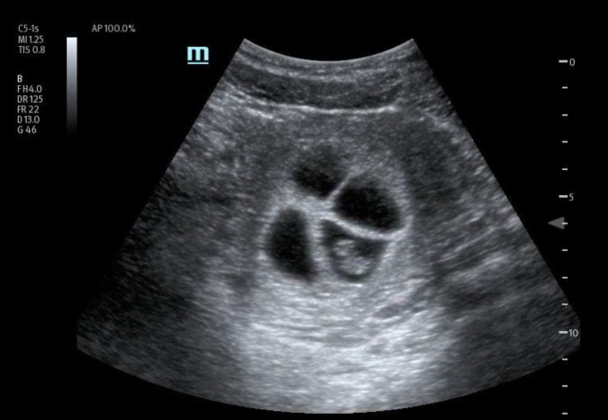 Optimizing Care for High-Risk Multiple Pregnancy with POCUS - A Case of Quadruplet Pregnancy Early Diagnosis.