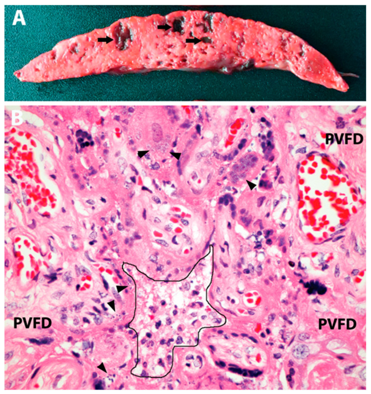 SARS-CoV-2 Infection in Late Pregnancy and Childbirth from the Perspective of Perinatal Pathology.