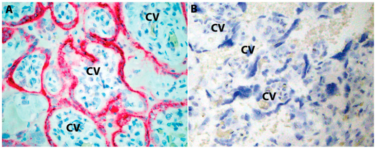 SARS-CoV-2 Infection in Late Pregnancy and Childbirth from the Perspective of Perinatal Pathology.