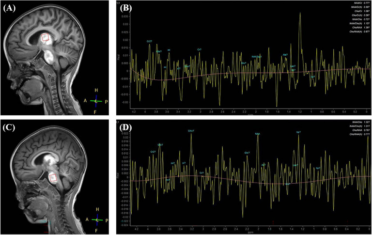 Recurrent infection triggered encephalopathy syndrome in a pediatric patient with <i>RANBP2</i> mutation and severe acute respiratory syndrome coronavirus 2 infection.