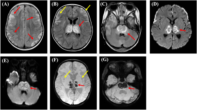 Recurrent infection triggered encephalopathy syndrome in a pediatric patient with <i>RANBP2</i> mutation and severe acute respiratory syndrome coronavirus 2 infection.