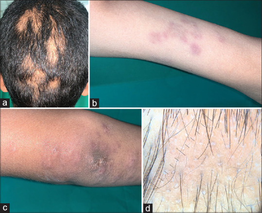 Mucinous Lupus Alopecia with Papulonodular Mucinosis as a Sole Cutaneous Manifestation of Systemic Lupus Erythematosus.
