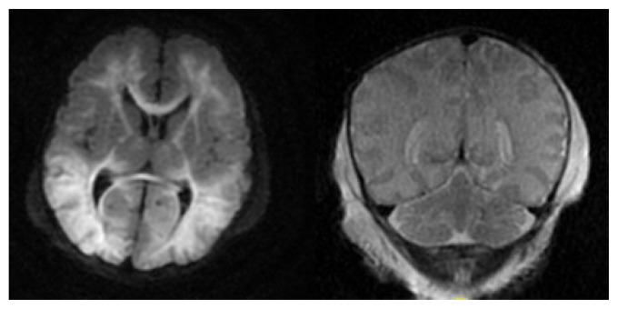 Human Parechovirus Associated Critical Illness in Neonates and Infants: Case Series and Review of Literature.