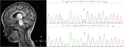 Recurrent infection triggered encephalopathy syndrome in a pediatric patient with <i>RANBP2</i> mutation and severe acute respiratory syndrome coronavirus 2 infection.