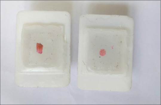 A Cross-sectional Observational Study to Correlate the Trichoscopic Findings of Female Pattern Hair Loss with the Disease Severity and Underlying Histopathological Changes.