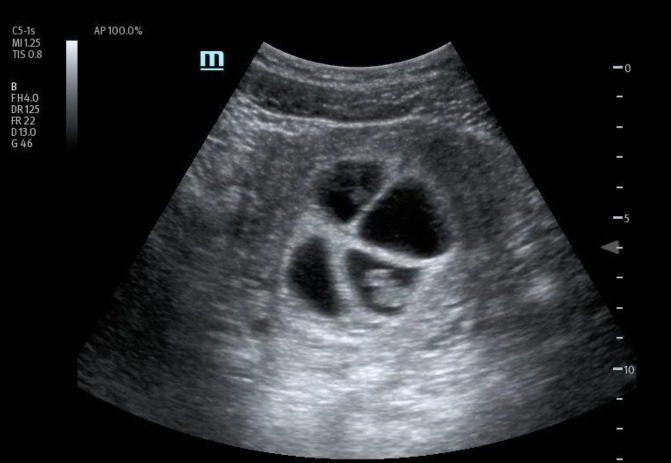 Optimizing Care for High-Risk Multiple Pregnancy with POCUS - A Case of Quadruplet Pregnancy Early Diagnosis.