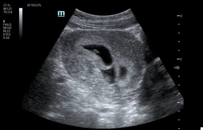Optimizing Care for High-Risk Multiple Pregnancy with POCUS - A Case of Quadruplet Pregnancy Early Diagnosis.