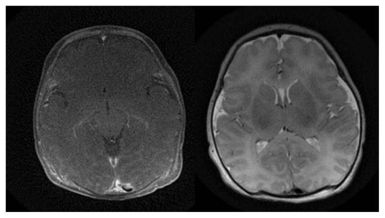 Human Parechovirus Associated Critical Illness in Neonates and Infants: Case Series and Review of Literature.