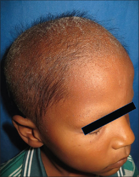 Rare Association of Congenital Atrichia with Central Nervous System: A Report of Three Cases.