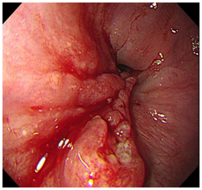 Simultaneous presentation and resection of esophageal cancer and metastasis to the pancreas: Α case report and literature review.