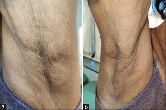 Graham-Little-Piccardi-Lassueur Syndrome with Mucosal Involvement: A Rare Case.