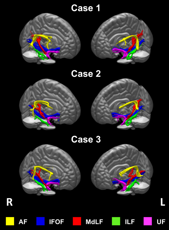 Automated Tractography for the Assessment of Aphasia in Acute Care Stroke Rehabilitation: A Case Series.