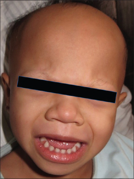 Rare Association of Congenital Atrichia with Central Nervous System: A Report of Three Cases.