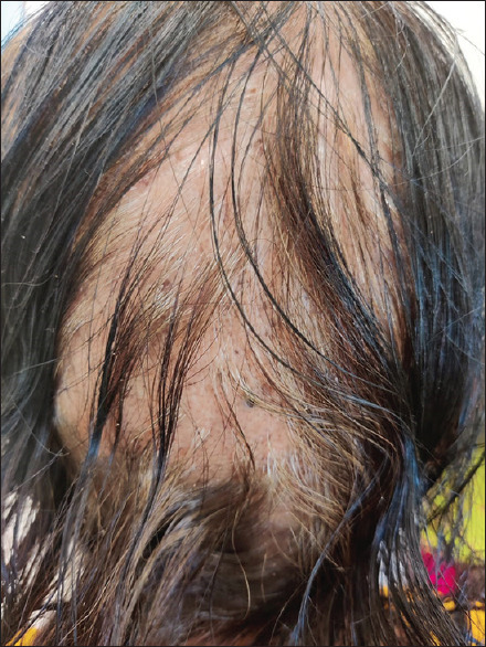 Graham-Little-Piccardi-Lassueur Syndrome with Mucosal Involvement: A Rare Case.