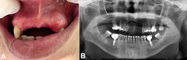 Gingival cyst of the adult.