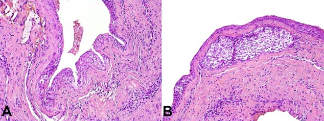 Gingival cyst of the adult.