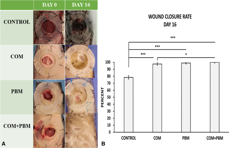 Promising improvement in infected Wound Healing in Type two Diabetic rats by Combined effects of conditioned medium of human adipose-derived stem cells plus Photobiomodulation.