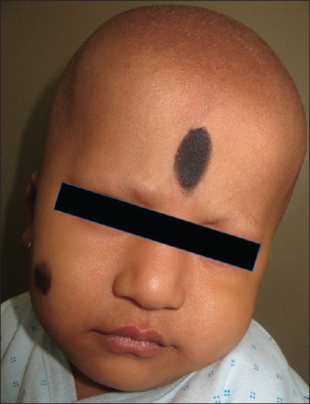 Rare Association of Congenital Atrichia with Central Nervous System: A Report of Three Cases.