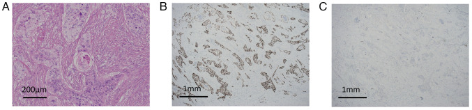 Simultaneous presentation and resection of esophageal cancer and metastasis to the pancreas: Α case report and literature review.