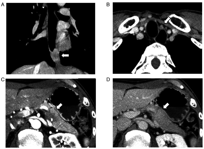 Simultaneous presentation and resection of esophageal cancer and metastasis to the pancreas: Α case report and literature review.