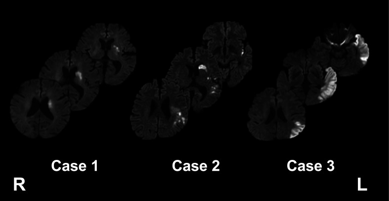 Automated Tractography for the Assessment of Aphasia in Acute Care Stroke Rehabilitation: A Case Series.