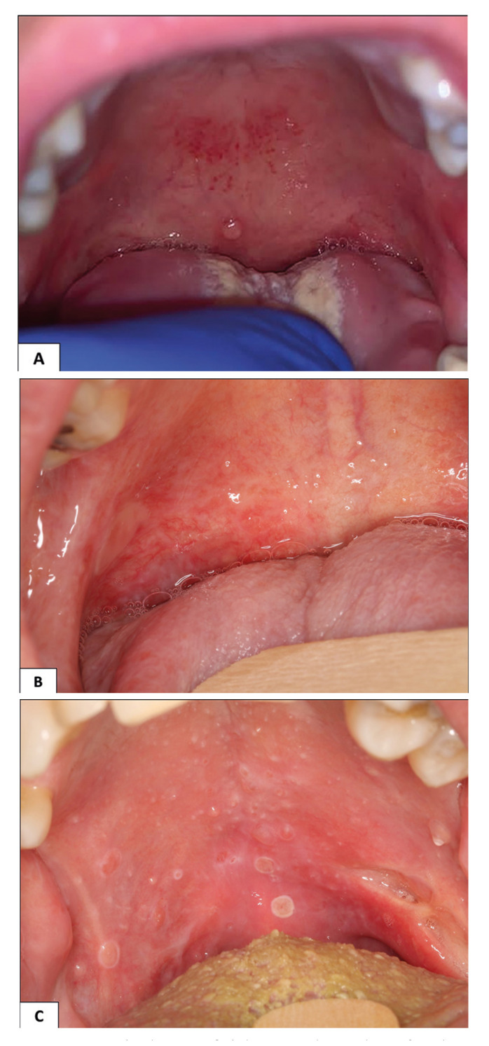 Superficial mucoceles in cancer patients: a retrospective series from a Stomatology unit.
