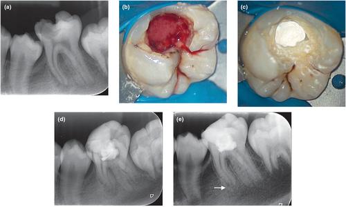 Vital pulp therapy for permanent teeth with diagnosis of irreversible pulpitis: biological basis and outcome