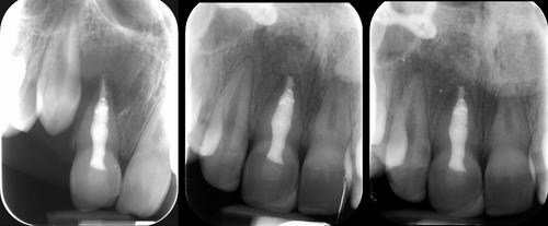 Endodontic–orthodontic interactions: a review and treatment recommendations