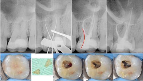 A review of the latest developments in rotary NiTi technology and root canal preparation