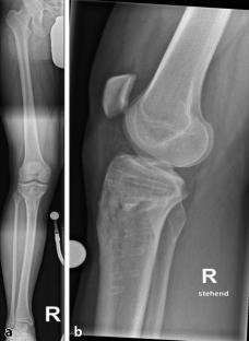 Physiologisierende Revisionsosteotomie nach proximaler Tibia-Umstellung zur Slopevergößerung