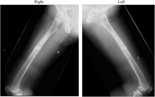 The Effect of Asfotase Alfa on Plasma and Urine Pyrophosphate Levels and Pseudofractures in a Patient With Adult-Onset Hypophosphatasia