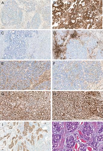 Immunohistochemical characteristics and potential therapeutic regimens of hepatoid adenocarcinoma of the stomach: a study of 139 cases