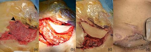 Soft tissue reconstruction of the trunk with pedicled perforator and musculocutaneous flaps: A single-center comparative retrospective study