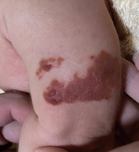 Brown crusts on infant owing to contact dermatitis associated with ethanol disinfection