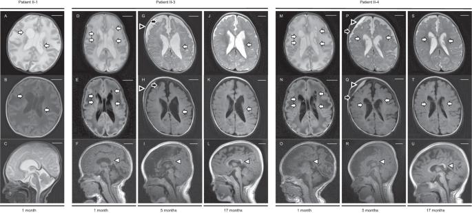 Novel missense variants cause intermediate phenotypes in the phenotypic spectrum of SLC5A6-related disorders