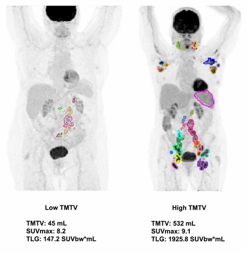 A low total metabolic tumor volume independently predicts for a longer time to first treatment in initially observed, low tumor burden follicular lymphoma