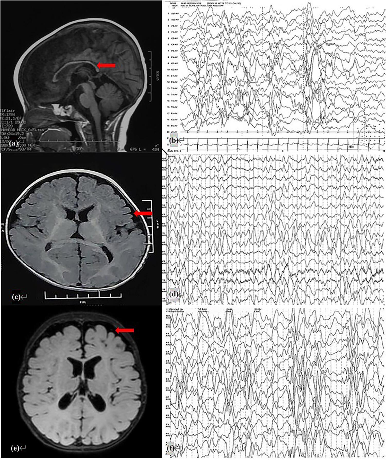 Infantile epileptic spasm syndrome as a new NR2F1 gene phenotype