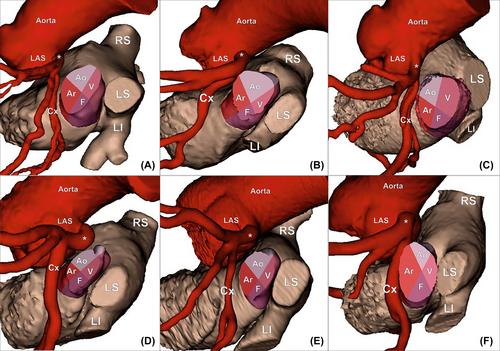 Definition and anatomical description of the left atrial appendage neck