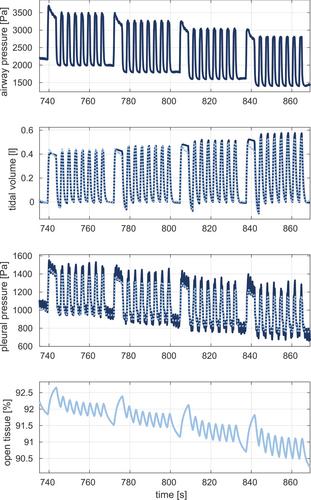 Pressure- and time-dependent alveolar recruitment/derecruitment in a spatially resolved patient-specific computational model for injured human lungs